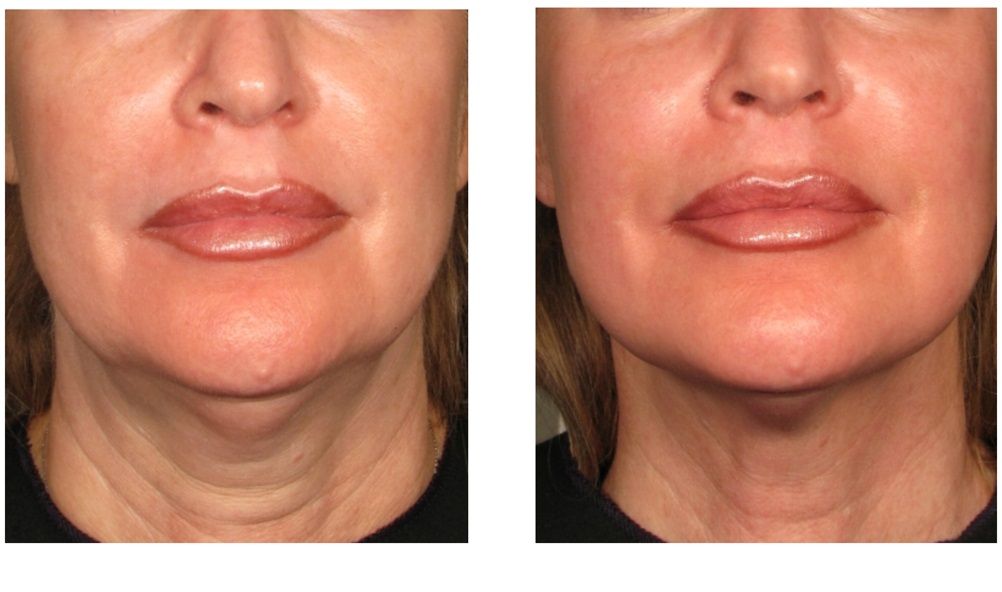 HIFU treatment